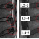 흔적 님의 요추디스크 L2-3, L3-4, L4-5의 MRI사진 판독입니다. (두번째) 이미지