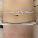 2호선 동백역 3번출구 | [부산] 해운대 부산슬리밍 미엘르 에스테틱 빼고 싶다 똥배 싹둑 복부관리 후기