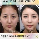 눈코지방이식_여신미모완성ING강남아이앤지성형외과