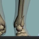 Bimalleolar fracture of ankle 이미지