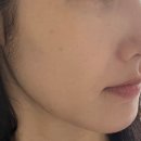 청담동피부과 온다리프팅 후기
