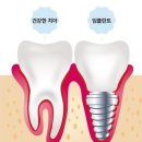 오랫동안 건강하게 슬기로운 임플란트 생활 이미지