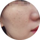 다드멍 | 절대 비추.. 매우 아픔 / 명동 피부과 / 안맞는 피부 / 주사바늘 자국 / 멍 자국 / 회복과정 &amp; 오열 후기