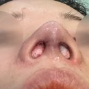 노즈랩의원 네이버블로그