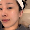 시티피부과의원 | 부산해운대센텀시티피부과, 팔자주름 써마지 대신 볼뉴머 리프팅 찐후기 (볼패임)