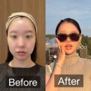 라임피부관리 | 부산 울쎄라피프라임, 출산 후 관리 내돈내산 후기