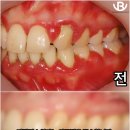 어금니 잇몸 부음 통증 이시림통증 양치질피 물방울 레이저 잇몸치료