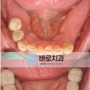 누리치과의원 | 대구 임플란트 잘하는곳, 타 치과에서 불가능 판정을 받은 고난도 사례
