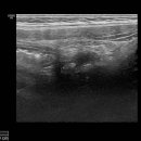 R/O appendicitis 이미지