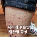 열이반점 이미지