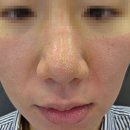누우래 | 경기광주피부과 블리비 경기광주점에서 모공관리 카프리레이저 프락셀 제네시스 후기