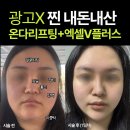 엑셀고급 | 내돈내산 온다리프팅 엑셀V플러스 후기 (ㄹㅇ대박임) 당일~1일차 전후비교