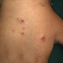 보명한의원 | 손등 편평사마귀 레이저로 보기 싫은 화상 흉터 남은 후기?