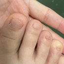 만별 | 발톱무좀 1순위(헤투토 발톱재생액+풀케어) 조합 후기 공유