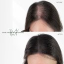 탈모왕수원 이미지