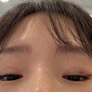 보라멍 | 쌍꺼풀 자연유착 재수술 첫날~3주차 후기 | 붓기, 멍, 부작용, 음주후기, ㄴㅅㅎ성형외과