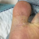 셀프케어약국 | 발바닥 발가락 사마귀 치료 셀프 제거 듀오케어 5일차 후기