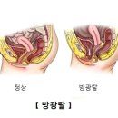 방광탈[[Cystocele] 신장비뇨기질환, 여성질환 이미지