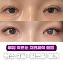 [쌍수 후기 3] 인아웃라인 쌍수 이틀-일주일차 후기 자연유착 윗트임 붓기 멍 통증 부작용 무쌍 작은눈...