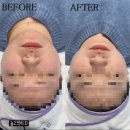 은계프라자 | 은계 피부관리 [세레누 피부&amp;왁싱 시흥점] 💆🏻‍♀️ 브이라인 윤곽 리프팅 ‘쏙프팅’ 리얼 후기