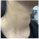 보험금 미지급 금감원 민원 신고 후기 / db손해보험 갑상선 고주파 실비 부지급