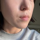 타이트짐 | 힘없이 처진 얼굴, 압구정 올타이트 리프팅으로 끌어올림! 올타이트 리프팅 통증 경과 후기