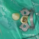 치과 크라운 튼튼하게 한 치료 후기 공개합니다 문정동 치과