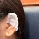 4공단로1L-13 | 귀 켈로이드(피어싱 살튀 부작용) 제거 수술 후기(+ 실비 청구)