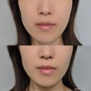 다이소화장품 브이라인 하이드로겔 V마스크팩 내돈내산