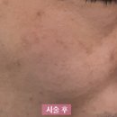 잠실예쁨주의쁨의원 | 잠실 예쁨주의 쁨의원 / 피코토닝, 클라리티2 잡티모드 / 얼굴잡티제거 레이저 후기