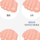 내성발톱 증상 원인 치료 이미지