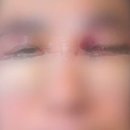 강남 성형외과서 눈밑지방 수술…눈 퉁퉁 붓더니 ‘실명’ 이미지