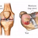 반월상 연골 이란 이미지