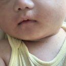 송화화장품 | 2주간의 태열•침독과의 전쟁🧨, 해결법💡, 병원방문🏥, 수딩젤 크림🧴 리얼 후기