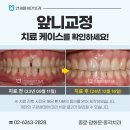 성인 치아 교정 1년 후기, 브라켓 인비절라인 차이 광화문치과