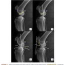 Blumensaat's line: 방사선 영상에서 전십자인대 파열을 예측하고 TTA 수술에 응용하기 이미지