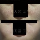 ★★★★★IPL로 잘안되는 흐린 잡티, 얼룩제거- 연세지움피부과 레블라이트레이저토닝.★★★★★ 이미지