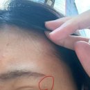 뷰티스톤의원 | [후기] 이수역 뷰티스톤 의원. 피부과 사마귀. 비립종 제거