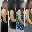 팔뚝 지방추출주사 3주차 리얼후기 (통증,멍,땡김,후관리)