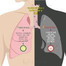 오른쪽 왼쪽 폐 통증 원인 및 치료 : 코로나 이미지