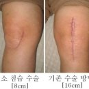 [무릎인공관절] 무릎인공관절수술 후 조기 보행 이미지