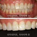 누리치과의원 | 주안동치과 후기 &#34;누런 니가 고민입니다 치아미백? 라미네이트? 어떻게 해야 좋을까요&#34;