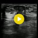 umbilical hernia 이미지