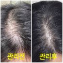 탈모샴푸추천 30대 여성 지루성두피염 탈모 관리방법 1개월 후기