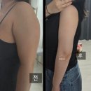 팔층피티(87PT) | 상체비만관리 전후 차이 있을까? 팔뚝지방흡입붓기 리얼 후기
