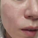 브이 | 잠실피부과 피부 기미 잡티 제거 아꼴레이드 색소침착관리 엑셀브이레이저후기