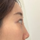 리블룸의원 | 원주피부과/10년 된 콧대필러 녹이기/ 오래된 필러 녹이기+턱윤곽 주사/아픔 강도/내돈내산/원주리블룸의원