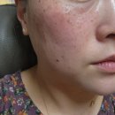 콜드플라즈마 | 잡티+주근깨 한방에! 대구피부샵 콜드플라즈마 후기 대공개