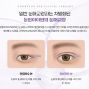 시흥 쌍꺼풀수술 알아본다면, 인천 논현동 눈성형 상담 전 체크할 점