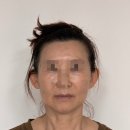 미인피부과의원 | 강남구청역피부과 레디어스 스킨 부스터 내돈내산 후기 비포애프터 포함